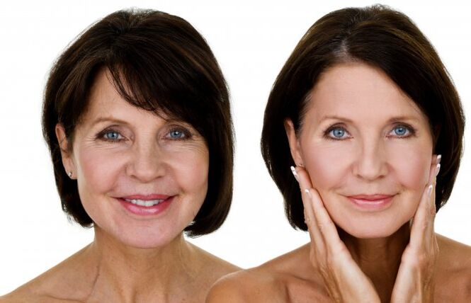 Before and after RF lift