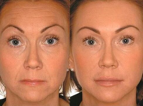 Before and after micronurrent therapy