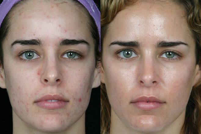 Laser grinding of the skin of the face in front and then